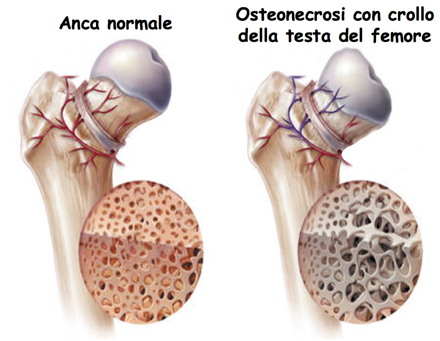 osteonecrosi2