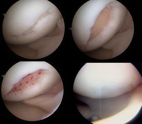 MICROFRATTURE
