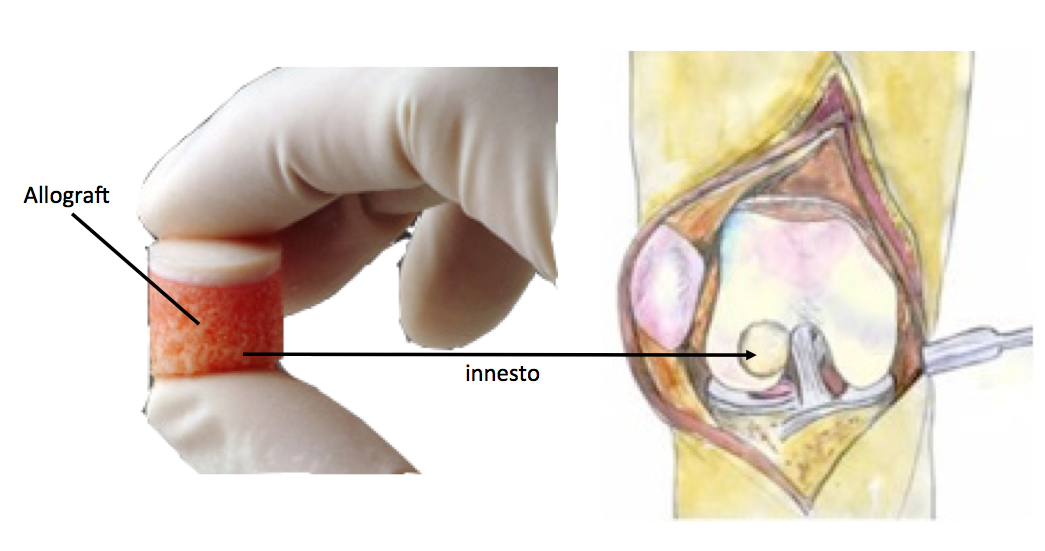 allograft