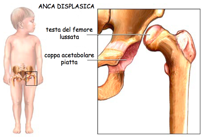 anca displasica