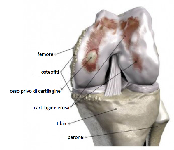 artrosi ginocchio