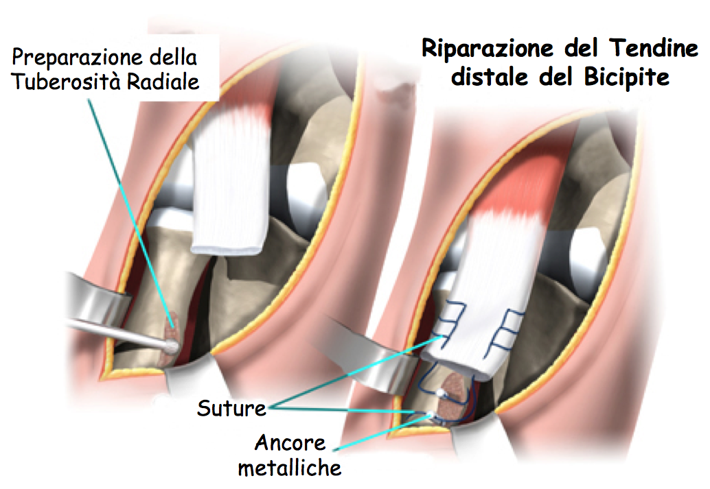 bicipite3