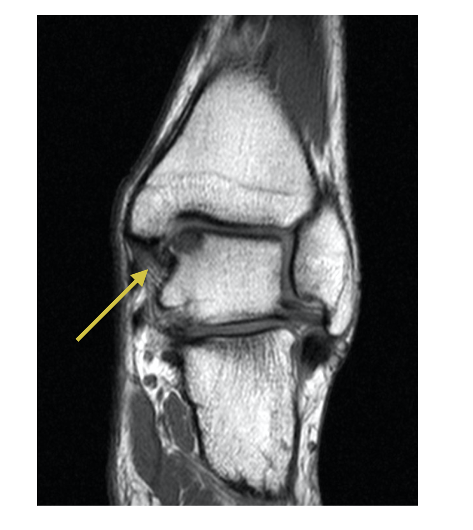 caviglia osteocondrite rmn