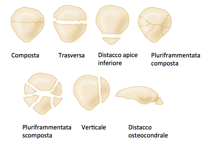 classificazione fratture rotula