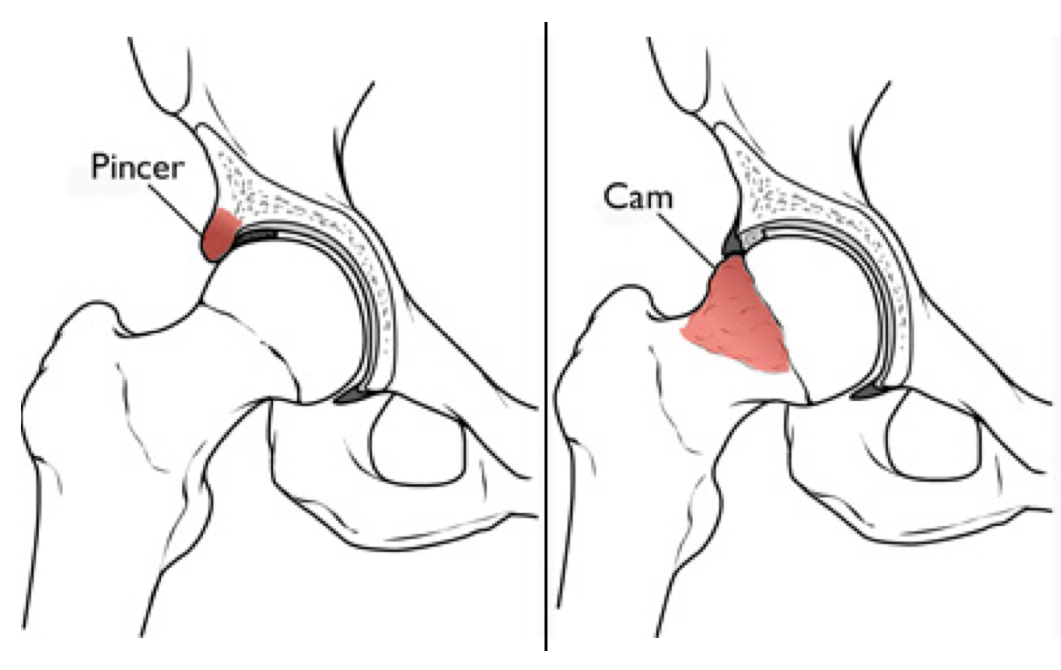 conflitto femoroacetab
