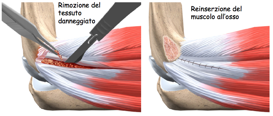 epicondilite trattamento