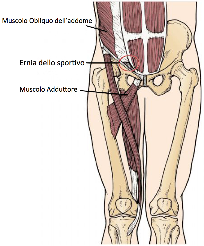 ernia dello sportivo 2