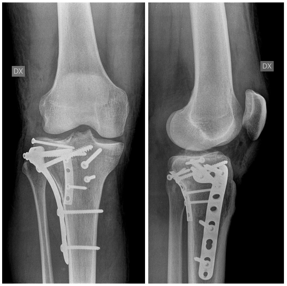 fratt piatt tibia post