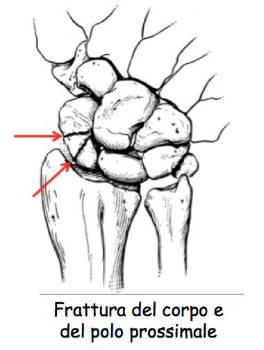 fratt scafoid2