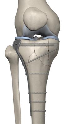 fratt tibia