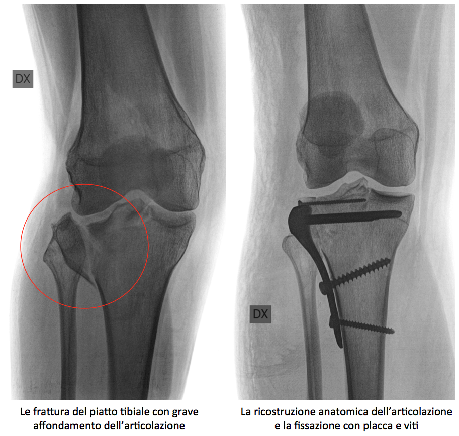 frattura intraarticolare  piatto tibiale