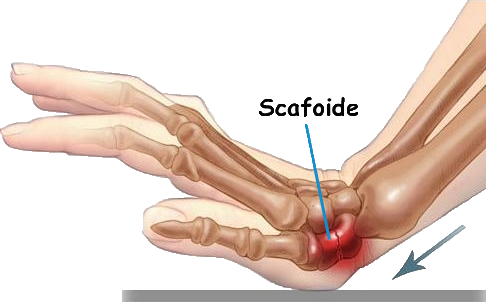 frattura scafoide2