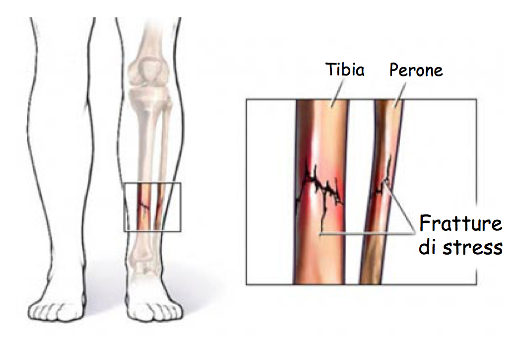 fratture da stress