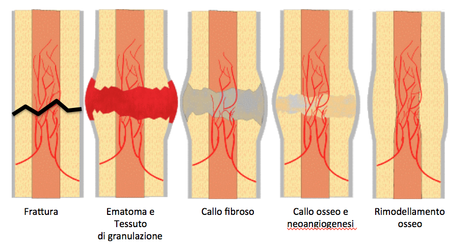 guarigione della frattura