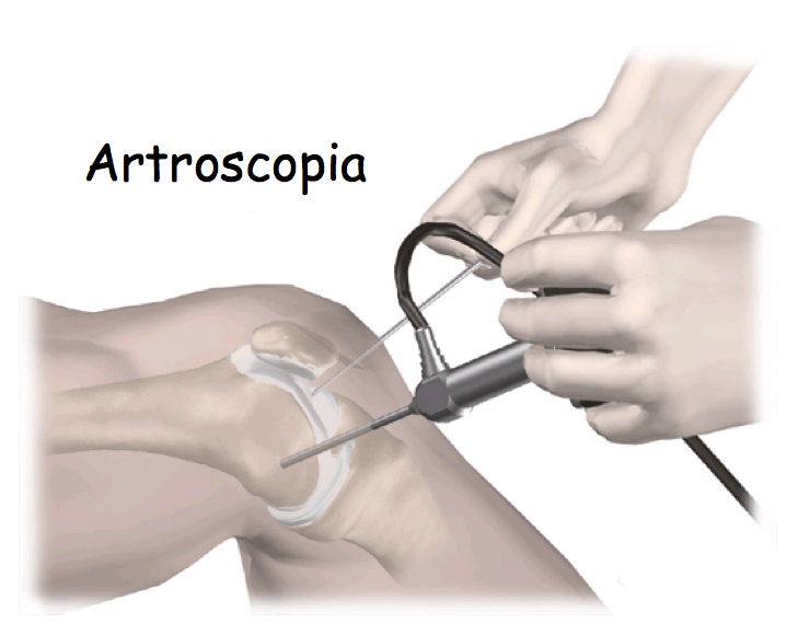 artroscopia