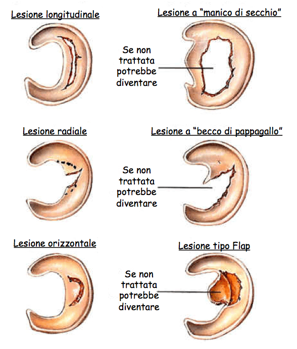 lesioni menisco tipi