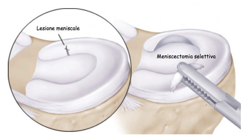 meniscectomia