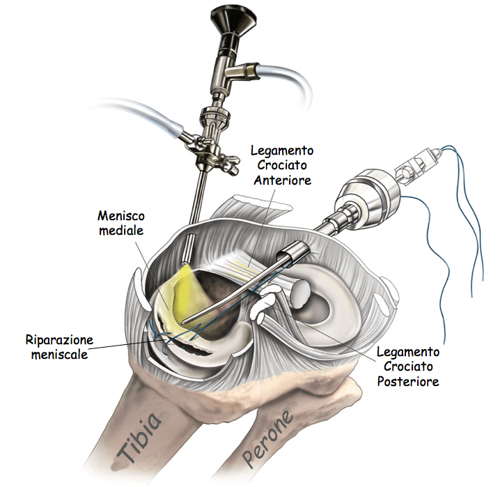 sutura meniscale