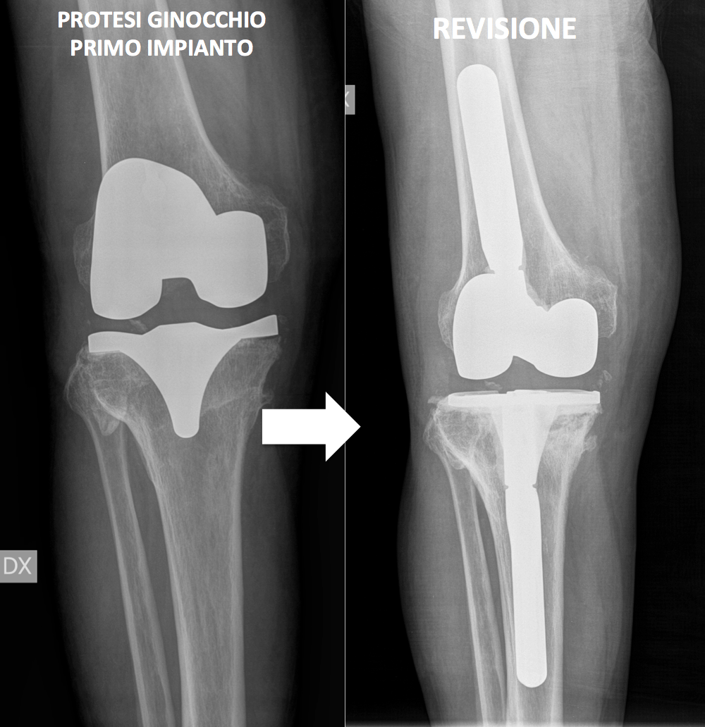 REVISIONE PROTESI DI GINOCCHIO