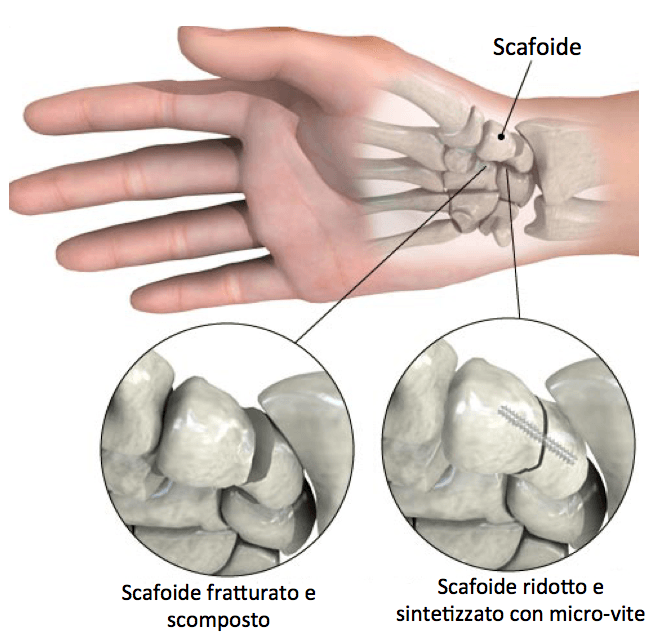 scafoide operato