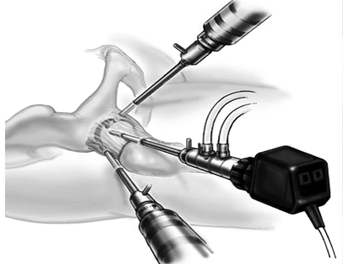 hip-arthroscopy