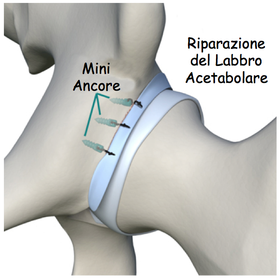 labbro acet5