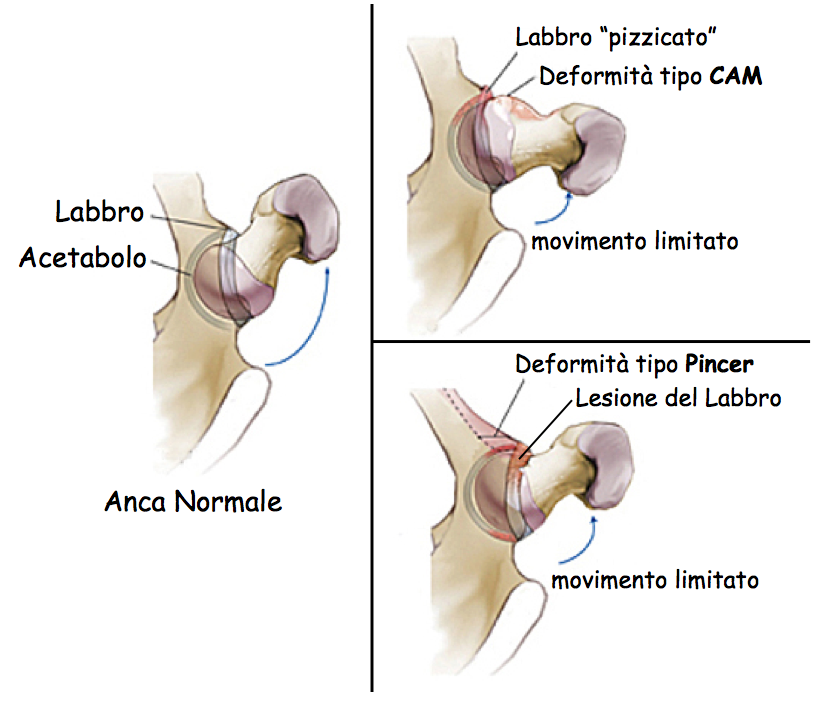 lesione labbro acetabolare