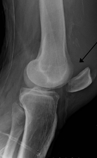 lesione quadrcipitale1