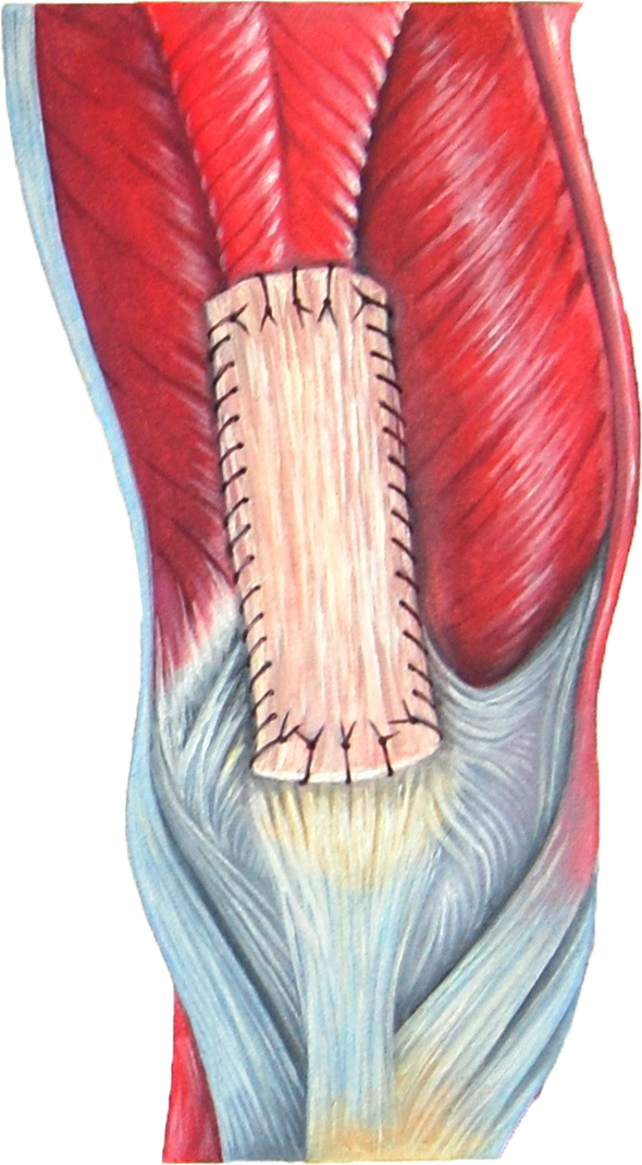 lesione quadric6