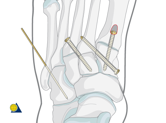 lisfranc4