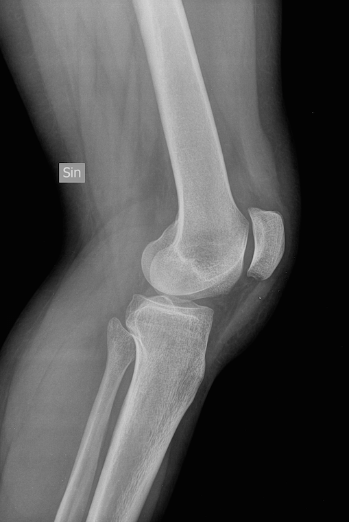 lussata rotula2