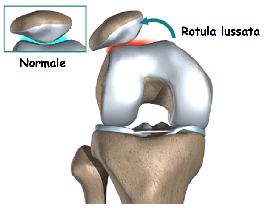 lussazione della rotula