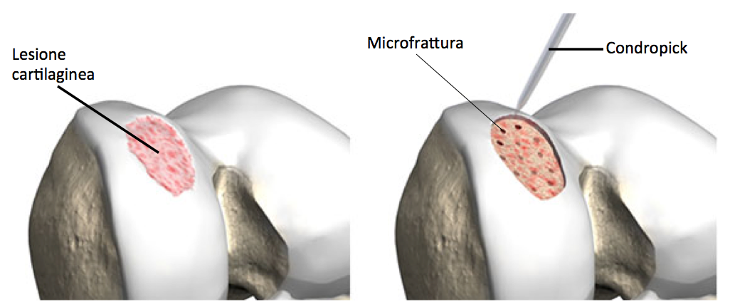 microfratture