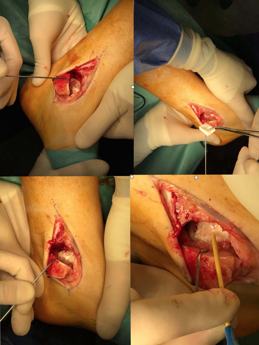 osteocondrite cartifill copia