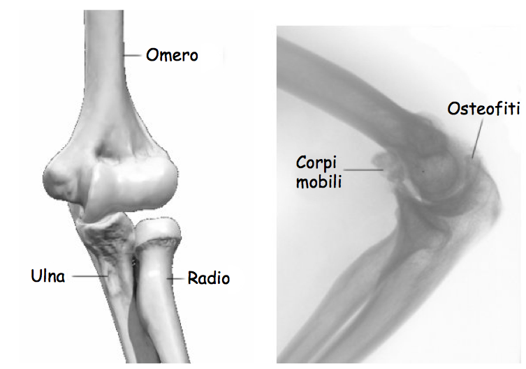 osteofiti gomito