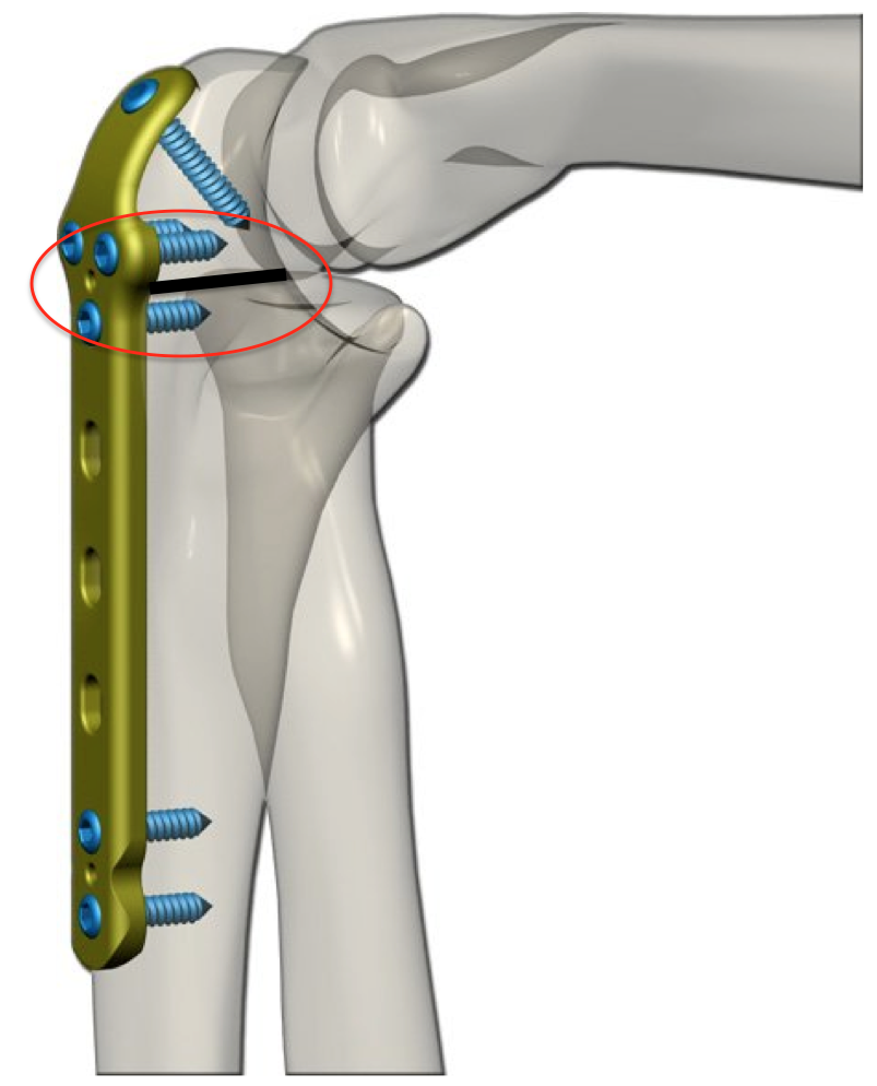 osteotomia olecrano