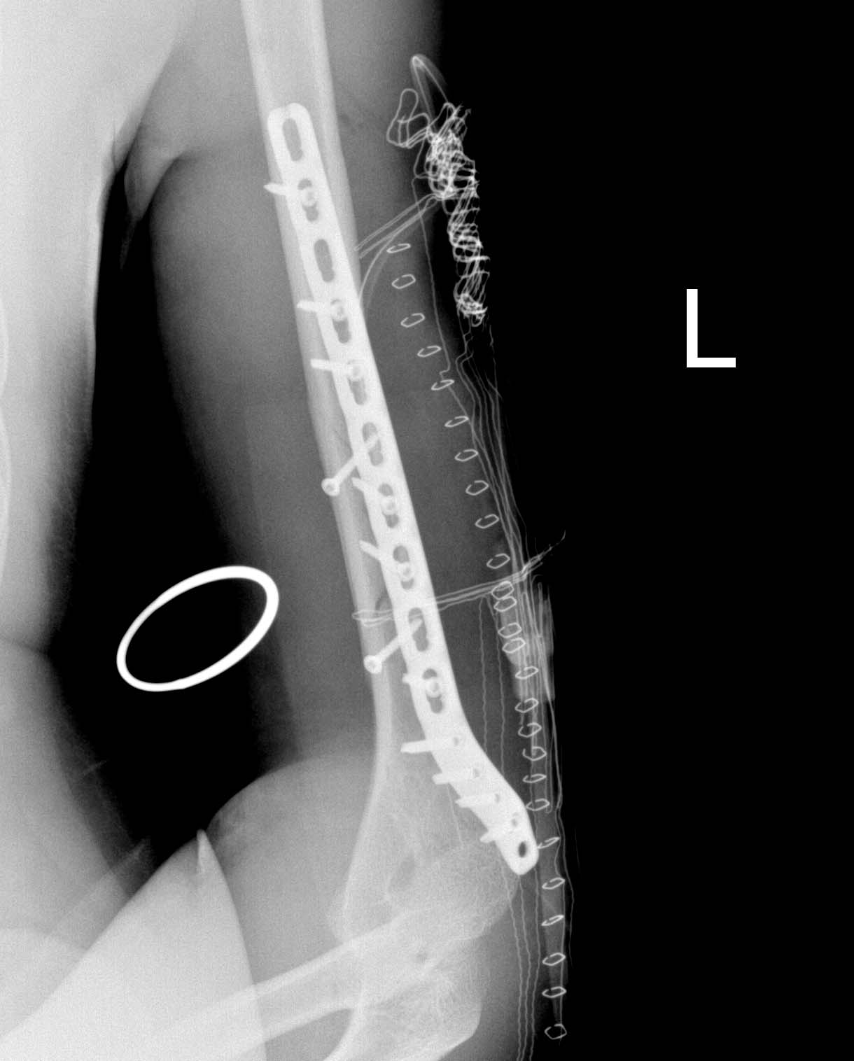 post op omero 