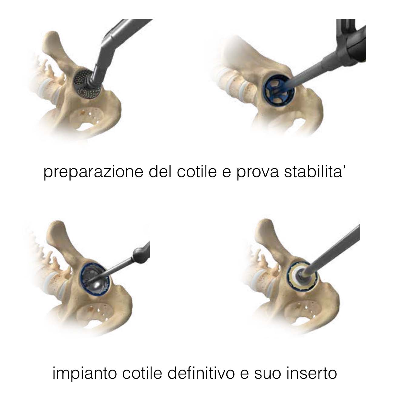 preparazione cotile