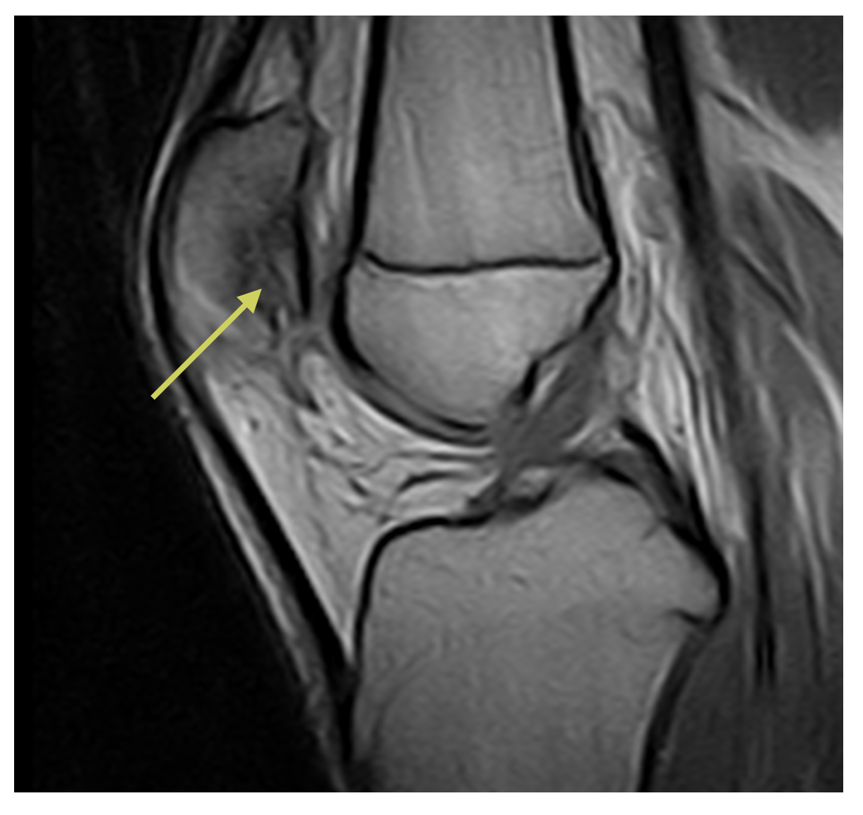 rmn osteocondrite