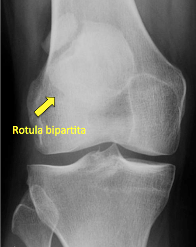 rotula bipartita