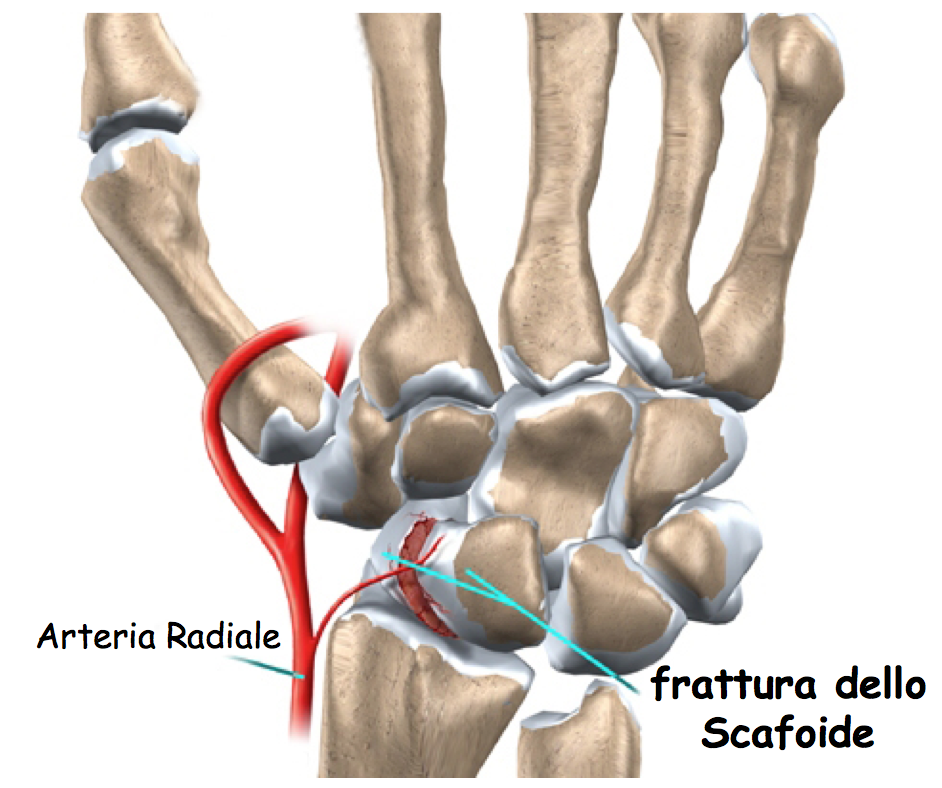 scafoide2