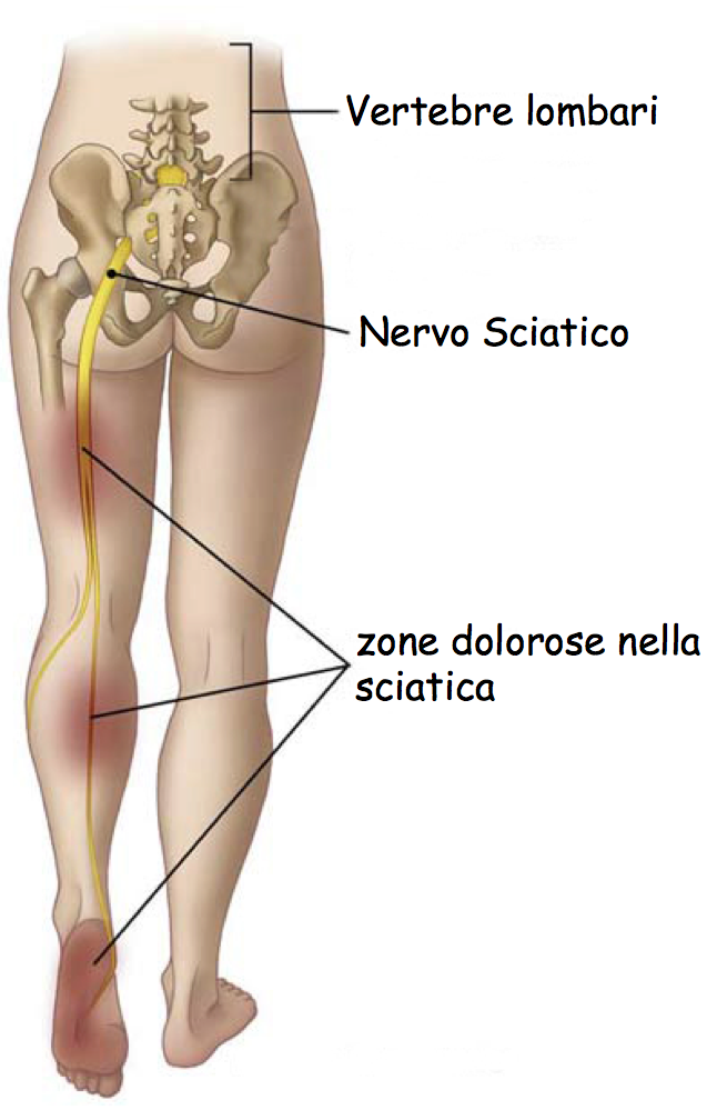 sciatica