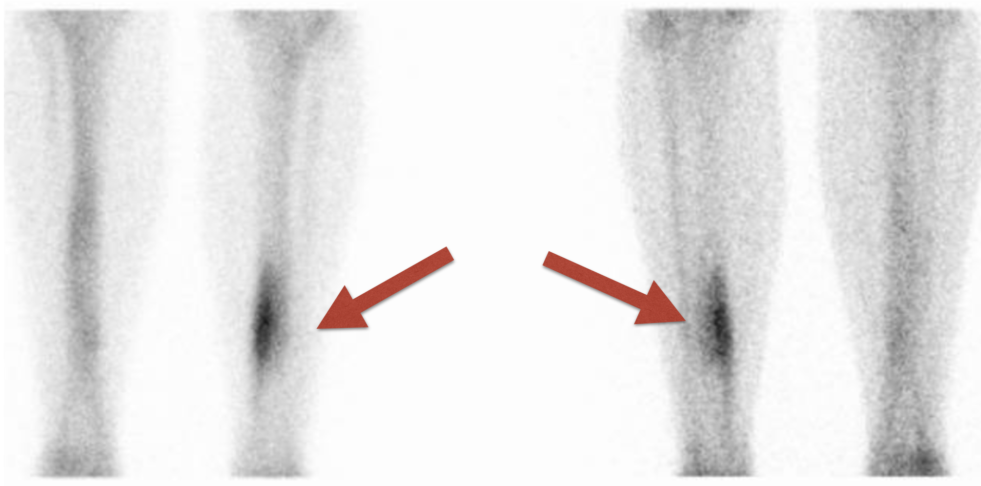 scinti tibia