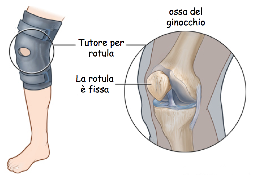 tutore di rotula