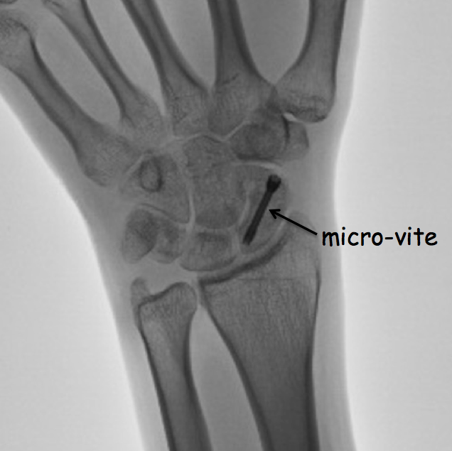 vitemicro scafoide